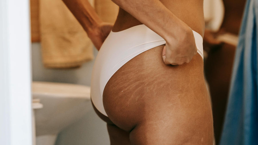 Stretch marks: what they are and how to treat them