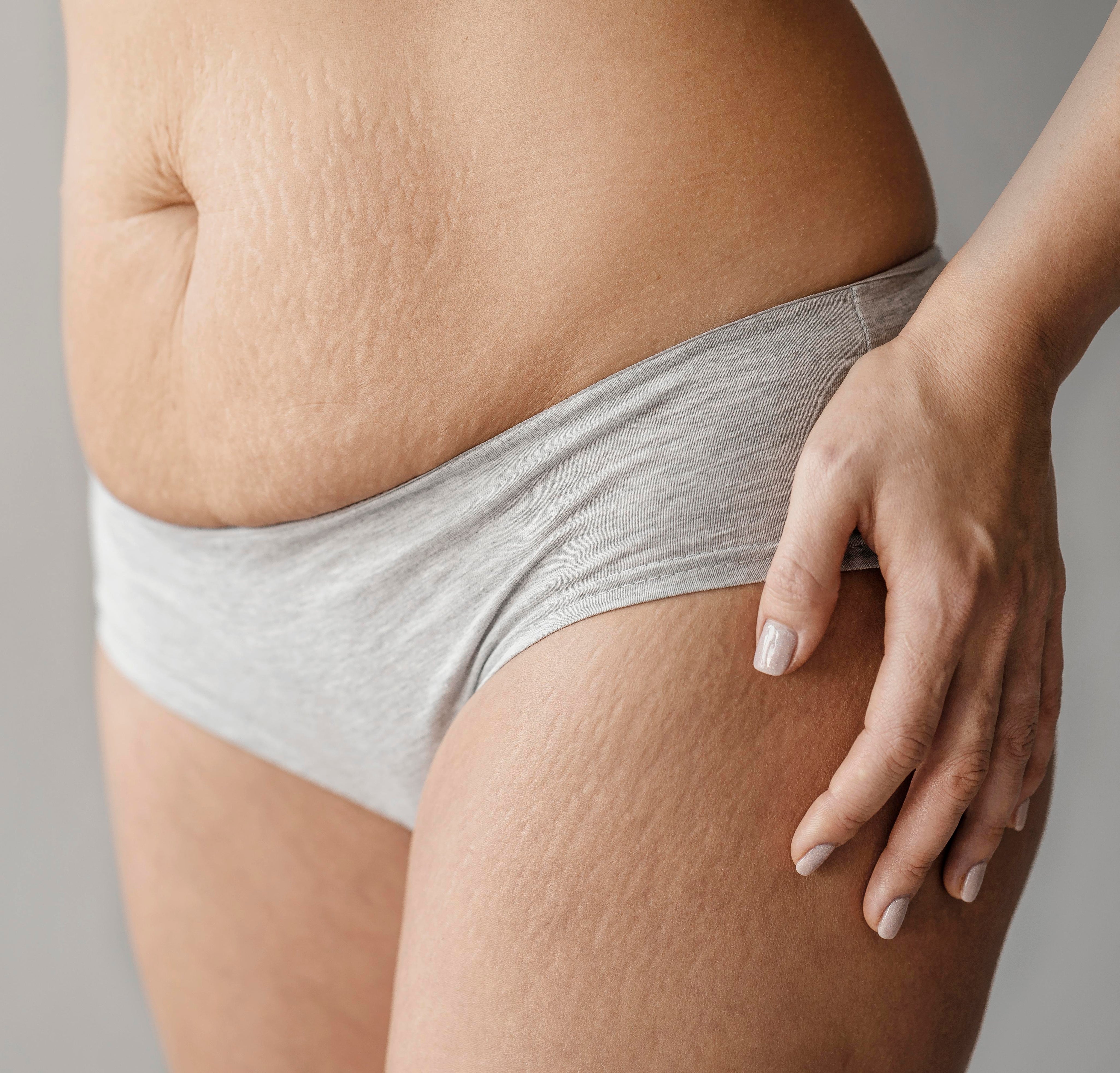 5 Cose da sapere sulle Creme Antismagliature (e perché dovresti iniziare ad usarle oggi stesso)